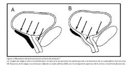 2025 08 01 Qué es la incontinencia urinaria (1)